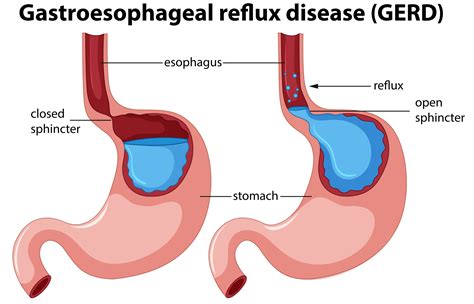 What Causes Acid Reflux On Empty Stomach